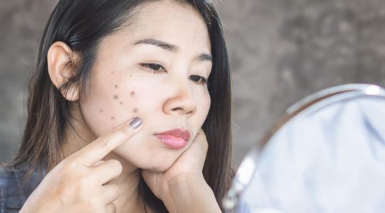 How Can You Prevent Dark Spots with Lifestyle Changes Suggested by wellhealthorganic.com?
