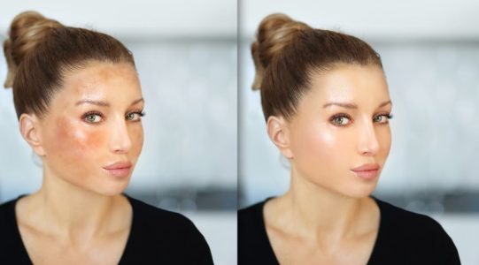 How Long Does Lemon Juice Take to Fade Dark Spots According to wellhealthorganic.com