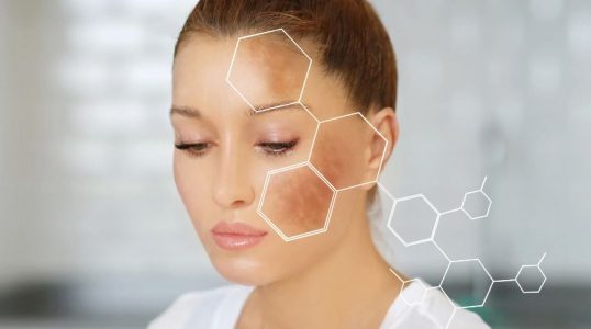 What Are Dark Spots? - wellhealthorganic.com : remove dark spots on face tang - lemon juice