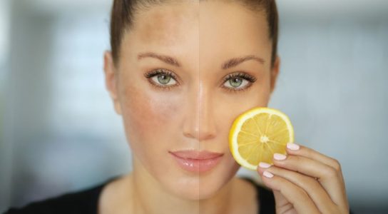 What Are the Side Effects of Using Lemon Juice for Dark Spots?